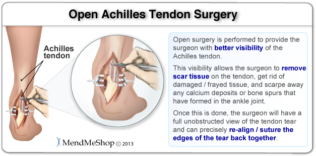 Open surgery is performed to provide the surgeon with better visibility of the Achilles, allowing the surgeon to remove scar tissue, damaged/frayed tissue, calcium deposits or bone spurs that have formed in the joint. Once done, the surgeon will have a full unobstructed view of the tendon tear and can precisely re-align/suture the edges of the tear back together.