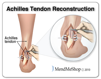 Complete Achilles tendon rupture require surgery to rejoin the tendon to the calcaneus or attach the tendon back together again.