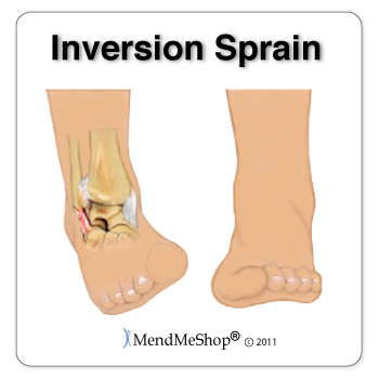A common cause of peroneal tendonitis is the stretching of the tendons during an inversion sprain or rolling over on your ankle.