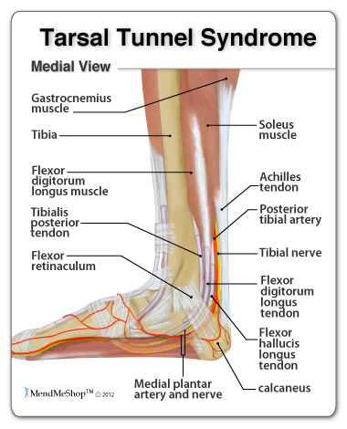 Tarsal Tunnel Syndrome (TTS) causes pain in the foot, ankle, and toes.