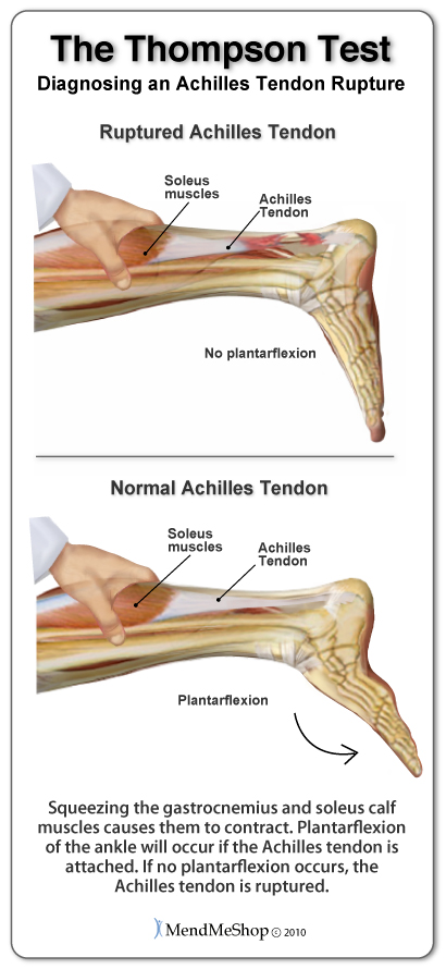 The doctor will use The Thompson Test to determine if the Achilles tendon is ruptured. When the calf muscles are squeezed, the foot should go into plantarflexion if the Achilles tendon is intact.